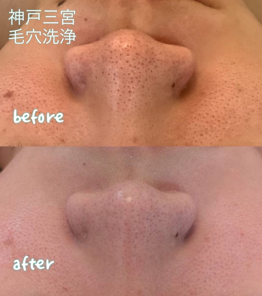 プラズマシャワープラズマフェイシャル