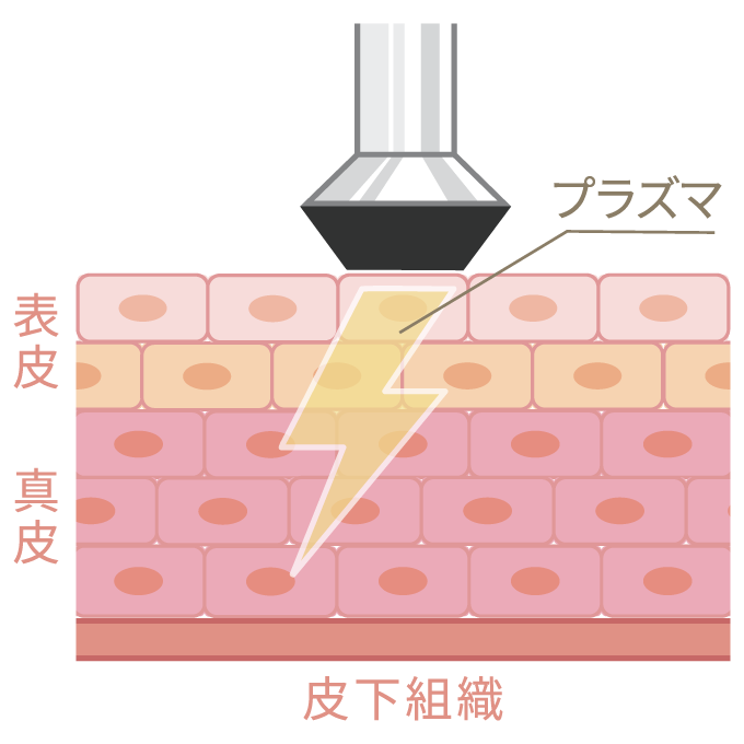 プラズマシャワーの照射イメージ