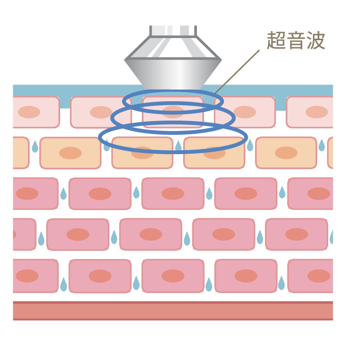 プラズマシャワーの超音波導入イメージ