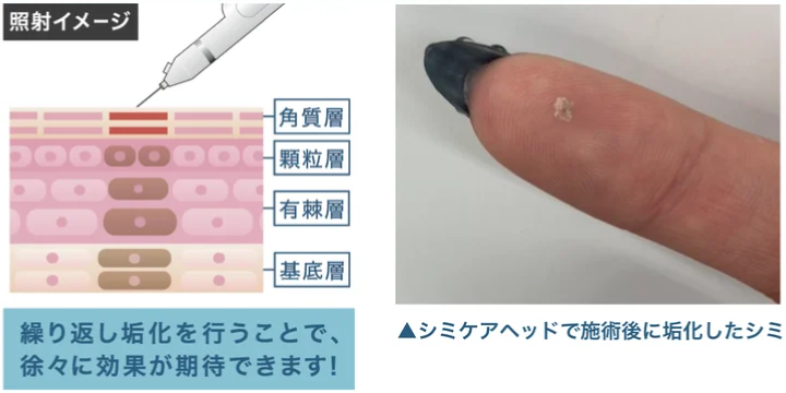 プラズマシミケアの照射イメージ